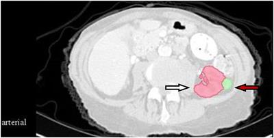 Research on automatic classification technology of kidney tumor and normal kidney tissue based on computed tomography radiomics